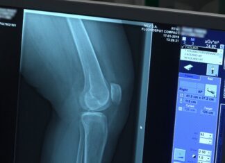 W wyniku pandemii tysiące chorych na osteoporozę pozostają bez pomocy. Lekarze i pacjenci apelują o proste zmiany umożliwiające diagnostykę i leczenie [DEPESZA]